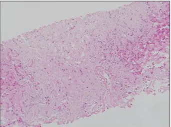 Fig.  3.  Microscopic  finding  of  the  liver.  Amorphous  pinkish  hya- hya-line  deposits  are  noted  in  the  hepatic  parenchyma  (H&amp;E  stain, 