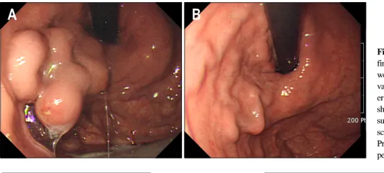 Fig.  1.  (A)  Initial  endoscopic  finding.  Huge  gastric  varices  which  were  continuous  with  esophageal  varices  and  extending  along   less-er  curvature  are  seen