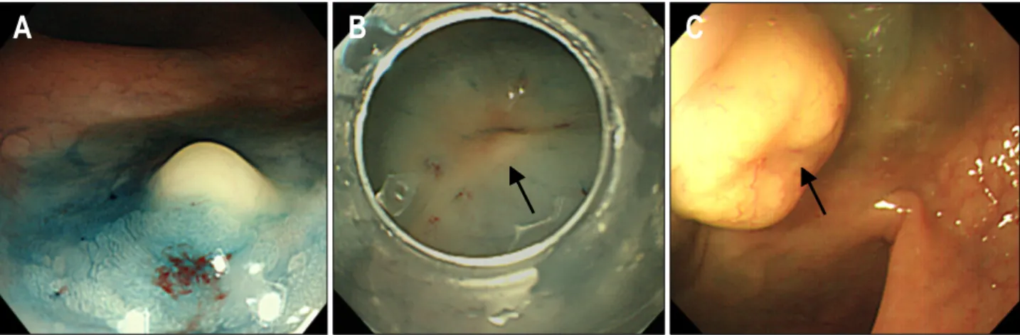 Fig.  2.  Endoscopic  finding  of  rectal  carcinoid  after  submucosal  injection  with/without  previous  biopsy