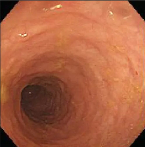 Fig.  1.  Colonoscopy  at  initial  admission.  Up  to  anal  verge  60  cm,  it  shows  multiple  patches  of  yellowish  flat  type.