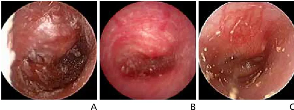 Figure 1.  Tympanic membrane findings for acute otitis media. (A,B) Hyperemia and severe buldging of the  tympanic membrane