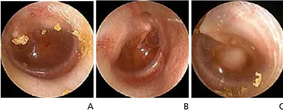Figure 2.  Tympanic membrane findings for otitis media with effusion (OME). (A) OME with small air bubble