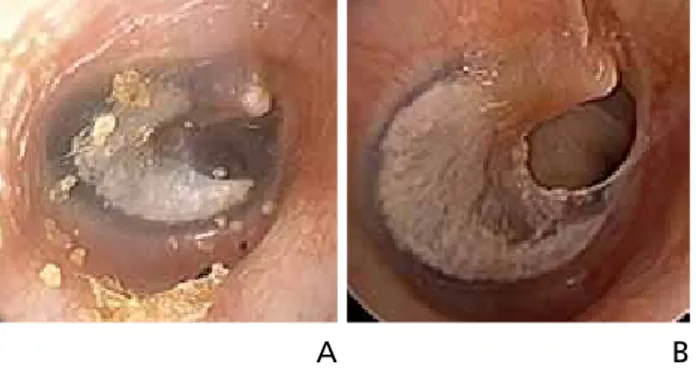 Figure 3.  Tympanic membrane findings for adhesive otitis media: an example 