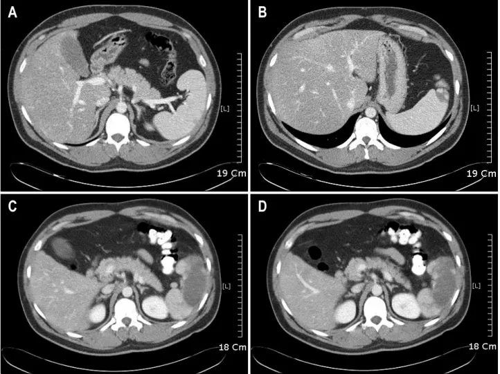 Fig.  1.  Initial  abdominal  CT  scan  shows  multifocal  low  density  in  spleen  by  infarction