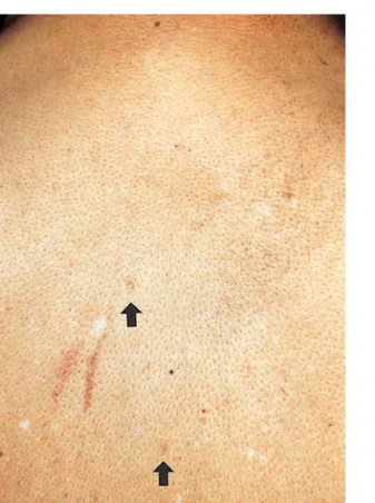 Fig. 1. Photograph  of  the  patient's  back.  Café  au  lait  spots  are  noted  (arrow).