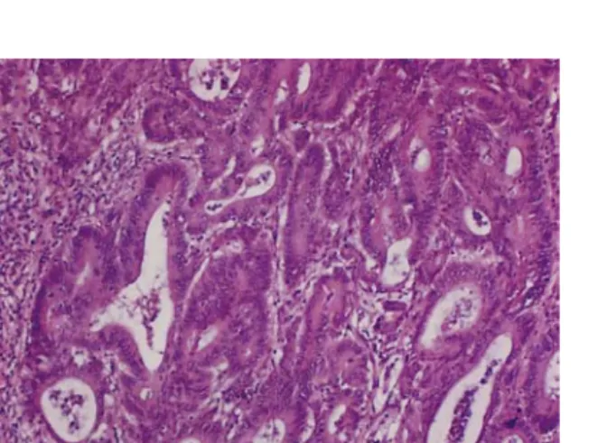 Fig. 5. Microscopic  finding  of  sigmoid  colon  cancer.  It  shows  moderately  differentiated  neoplastic  glands  extending  to  the  proper  muscle  layer  (H&amp;E  stain,  ×100).