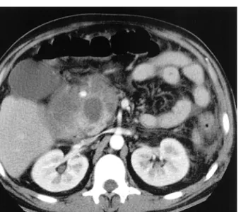 Fig. 1. Initial  abdominal  CT  finding.  Abdominal  CT  on  admission  shows  mild  peripancreatic  fluid  collection  without  cyst  formation.