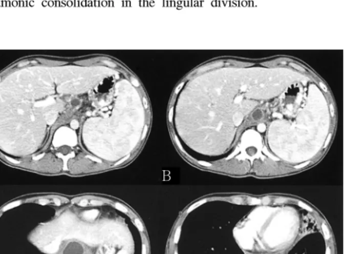 Fig. 2. Abdomen  and  chest  CT  on  admission.  (A)  It  shows  the  transitional  region  from  a  suprapancreatic  pseudocyst  to  a   medi-astinal  pseudocyst