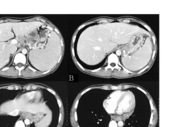 Fig. 5. Follow  up  abdomen  and  chest  CT  3  months  after  admission. 