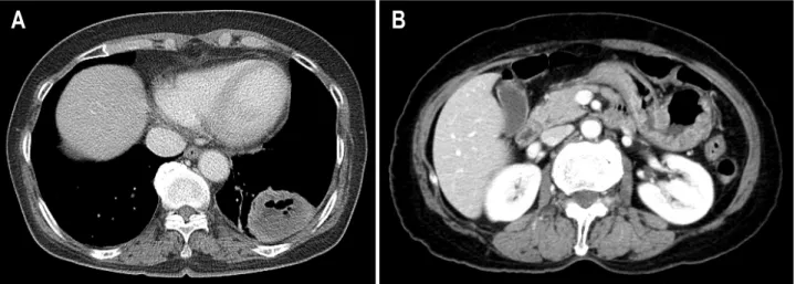 Fig.  1.  Chest  CT  scans.  (A)  5.4  cm  sized  cavitary  mass  in  left  lower  lobe