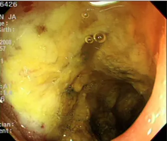 Fig.  2.  Endoscopic  finding  shows  ulceroinfiltrative  lesion  with  spontaneous  bleeding  in  proximal  jejunum.