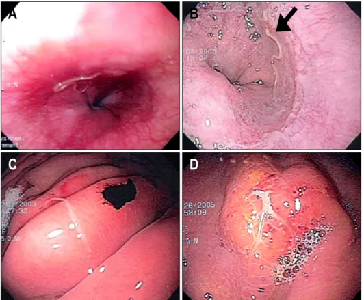 Fig  2.  The  location  of  the  worms  in  anisakiasis.  Each  dot  in- in-dicates  the  location  of  anisakid  larvae  found  during  upper   gastro-intestinal  endoscopy.