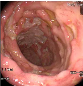 Fig.  1.  The  colonoscopic  finding  shows  multiple  and  discrete  ul- ul-cers  in  the  ascending  colon.