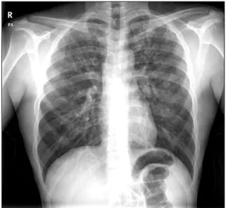 Fig.  2.  Chest  tomograph  shows  diffuse  ground-glass  opacities  with  some  air-consolidations  and  reticulonodular  infiltration  in  both  lungs,  mainly  upper  lobes.