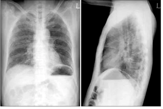 Fig.  1.  Chest  radiography.  There  is  reticular  opacity  at  both  lower  lung  fields