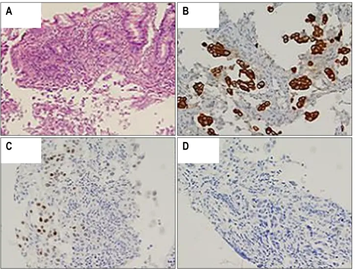 Fig.  3.  Microscopic  findings  of  the  cecal  mass.  Histology  shows  intact  colonic  mucosa  with  submucosal  tumor  nests  (A)  (H&amp;E,  ×100)