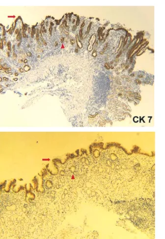 Fig. 3. Non-Barrett's CK 7/20 pattern in an endoscopic biopsy specimen from a patient with gastric intestinal metaplasia