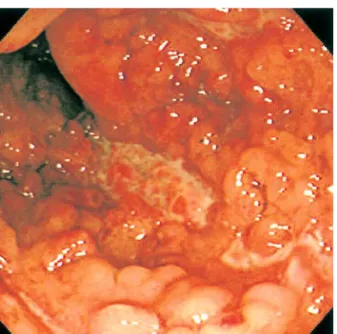Fig. 1. Colonoscopic finding. Cobble stone appearance with longitudinal ulcerations and edematous mucosa is observed on the entire colon.