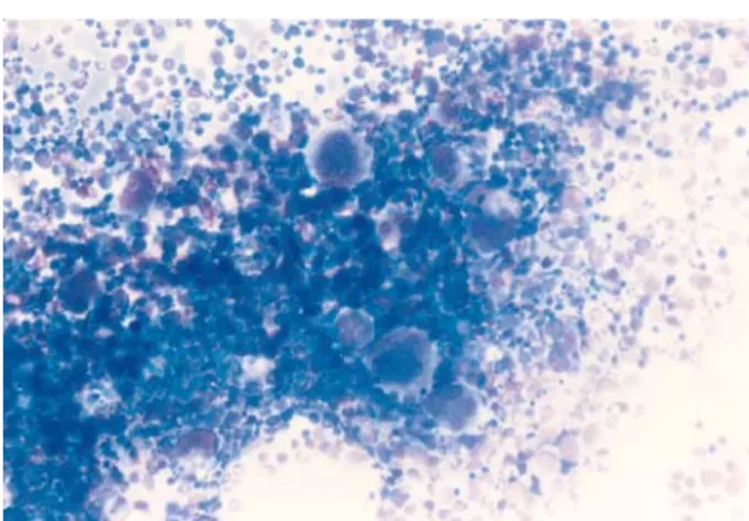 Fig. 3. Bone marrow aspirate finding. It reveals moderate megakaryocytic hyperplasia (Wright stain, ×200).