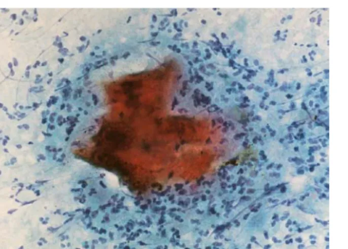 Fig. 4. Microscopic finding of Papanicolaou smear. It shows sulfur granules surrounded by inflammatory cells (Papanicolaou stain,