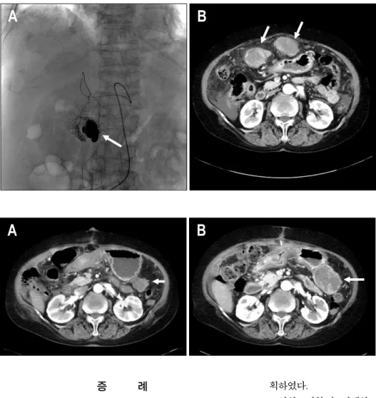 Fig.  1.  Angiography  and  CT  findings.  (A)  Emergency   trans-arterial  chemoembolization  is   per-formed  due  to  hepatoma  rupture  3  months  ago