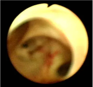 Fig.  4.  Operation  finding.  There  is  large  amount  of  mucin,  but  is  no  tumor  in  the  biliary  tract  by  naked  eye.