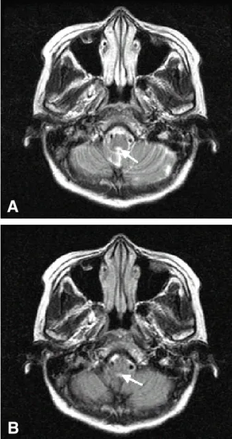 Fig. 1. Brian MRI. (A) Axial image from T2-weighted sequence demonstrates bright signal abnormality in the posterior medulla oblongata (arrow)