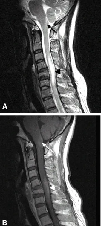 Fig. 2. Cervical spinal MRI. (A) Sagittal T2-weighted image of the cervical spine shows diffuse cord signal abnormality from C3 to C6 (black arrowhead) and linear signal abnormality in the posterior medulla oblongata (black arrow)