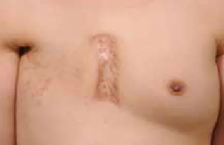 Figure 1.  Grade 3 dermatitis with confluent desquamation. 