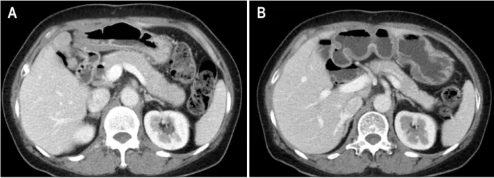 Fig.  4.  Abdominal  CT  image.  (A)  It  shows  sausage  shaped  pancreatic  swelling  (pretreatment)