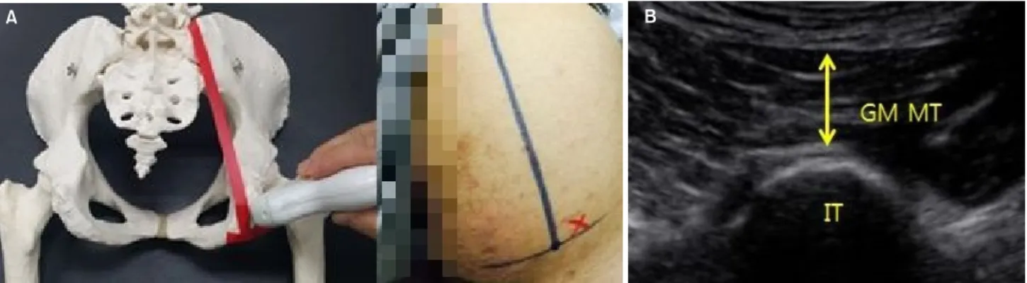 Figure 1. (A) Position of the probe to measure. (B) Rehabilitative ultrasound image of the GM