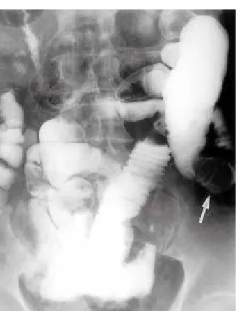 Fig. 1. Small bowel study of ileal mass. Barium radiography reveals incomplete obstruction of proximal ileum with barium outlining the polypoid-filling defect (arrow)