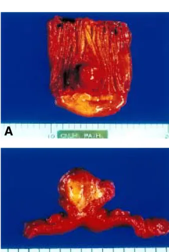Fig. 4. Microscopic finding of angiolipoma. The mass consists of mature fat cells and variable sized blood vessels (H＆E stain, ×40).