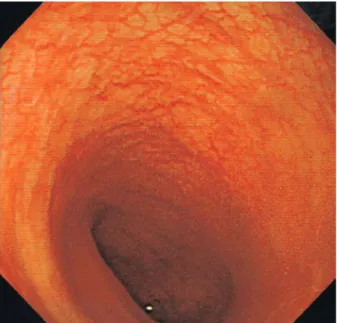 Fig. 4. Follow-up sigmoidoscopic finding. It shows the improvement of diffuse mucosal hyperemia and multiple ulcerations.