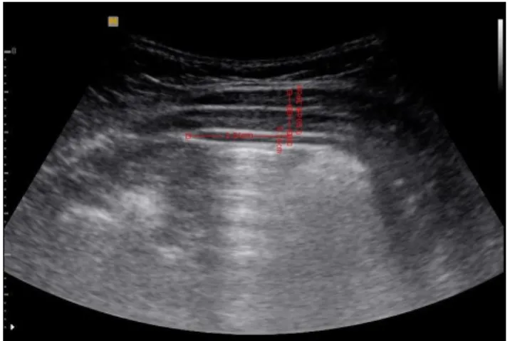 Figure 1. Placement of probe. Figure 2. Measurement of muscle thickness.