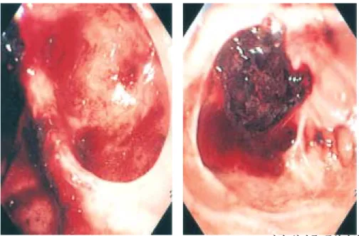 Fig. 1. Endoscopic finding. (A) Duo- Duo-denal diverticulum is divided into 2 portions by a septum