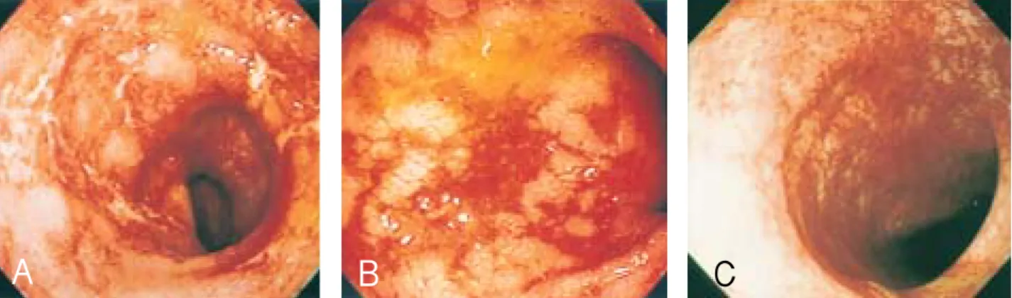 Fig. 1. Sigmoidoscopic findings. (A) Initial sigmoidoscopic examination at admission shows colitis with superficial ulceration, erythema, loss of submucosal vasculaity, edema and easy touch bleeding mimicking ulcerative colitis