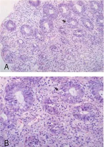 Fig. 2. Microscopic findings of the sigmoid colon. The section of biopsy specimen shows necrosis of individual crypt cells with apoptotic bodies (arrow)