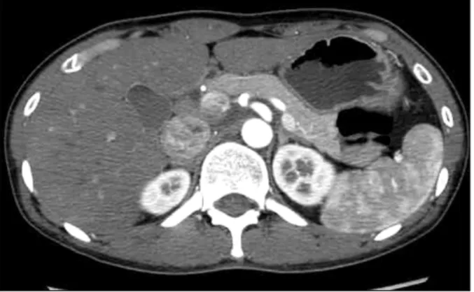 Fig.  1.  Contrast-enhanced  CT  finding  of  the  patient.  Pancreas  was  normal  looking  without  edema,  peripancreatic  infiltration,  or  fluid  collection