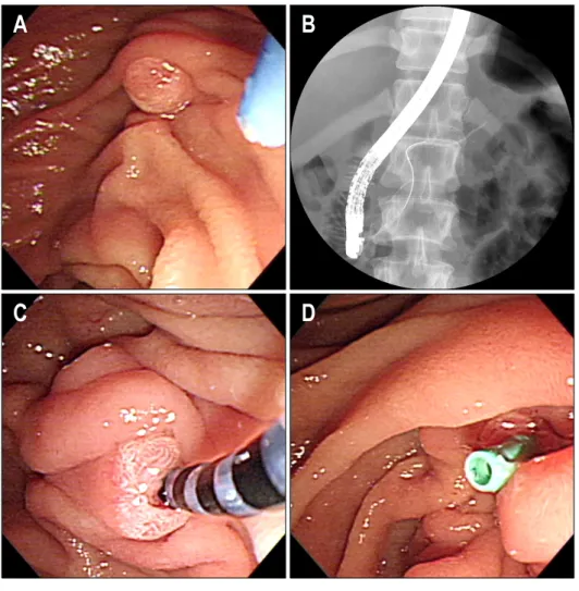 Fig.  2.  Endoscopic  retrograde  cho- cho-langiopancreatography  findings.  (A)  Major  duodenal  papilla  looked  normal