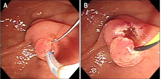 Fig.  4.  Endoscopic  treatment  with  pancreatic  sphincterotomy.  (A)  Using  a  pull-type  papillotome,  pancreatic  sphincter  was  cut