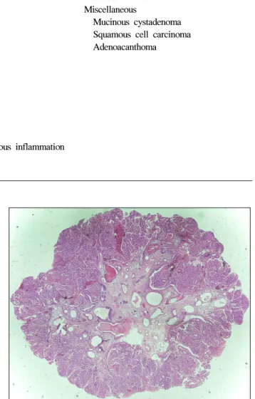 Fig.  2.  Microscopic  feature  of  the  adenomatous  polyp.  The  polyp  composed  of  glandular  structure  with  tall  columnar  epithelium  and  fibrous  stroma