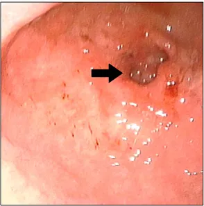 Fig.  1.  Gastroduodenoscopic  finding  showed  ulcerative  mass  of  anterior  wall  of  gastric  antrum  (arrow)