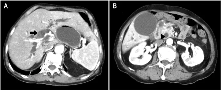 Fig.  3.  Abdominal  CT  findings.  (A)  There  was  diffuse  dilatation  of  intra-hepatic  bile  ducts  (arrow)
