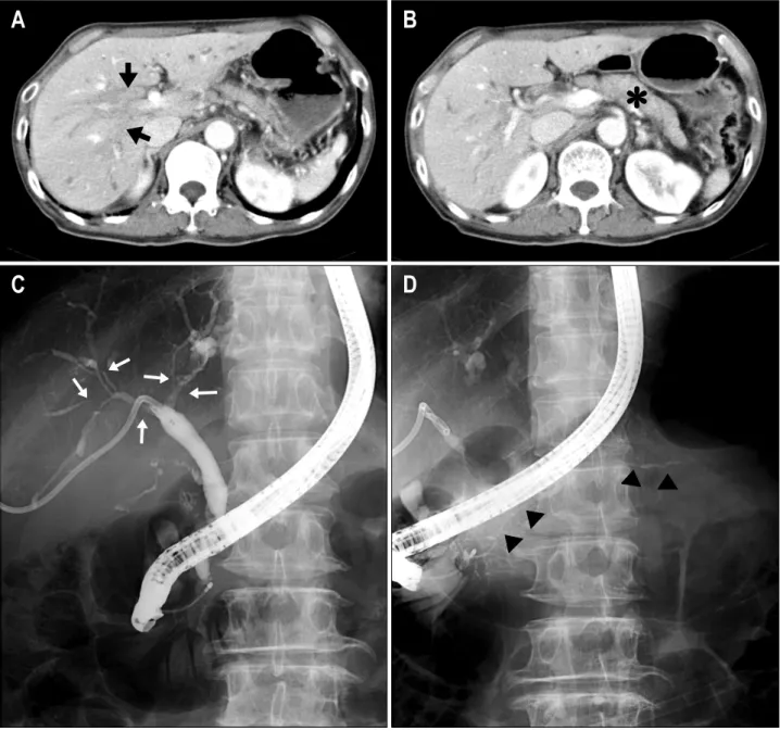 Fig.  1.  CT  and  ERCP  findings  before  steroid  treatment.  (A)  CT  scan  demonstrated  intrahepatic  biliary  dilatation  secondary  to  diffuse  stricturing  of  the  biliary  system  and  bile  duct  wall  thickening  at  hilar  portion  (black  ar