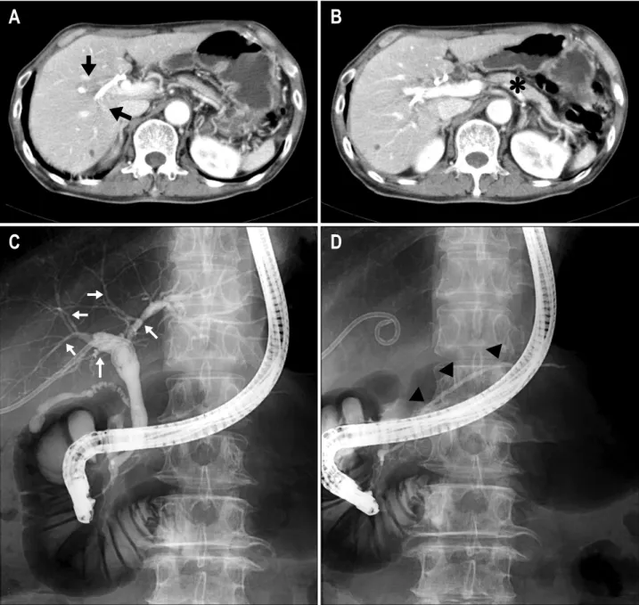 Fig.  2.  CT  and  ERCP  findings  after  4  weeks  of  steroid  treatment.  CT  scan  demonstrated  (A)  the  appearance  of  intrahepatic  biliary  tree  was  significantly  improved  (black  arrows)  and  (B)  the  size  of  pancreas  markedly  decrease