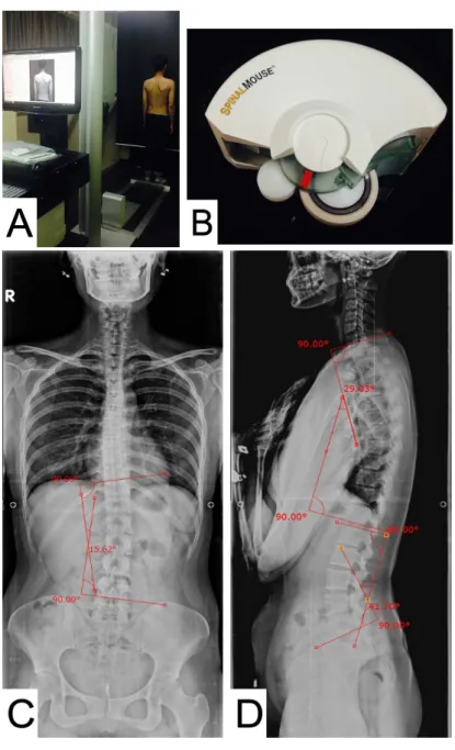 Figure 1. Back Mapper (A) Spinal Mouse (B) Cobb an- an-gle (C) kyphotic anan-gle (D) X-ray.