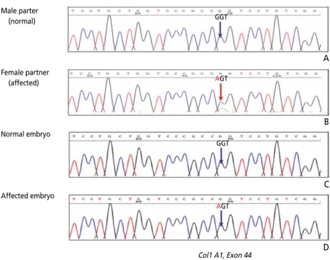 Figure 2.  Direct sequencing of the polymerase chain reaction product spanning exon 37 in the preimplanta- preimplanta-tion genetic diagnosis for osteogenesis imperfecta