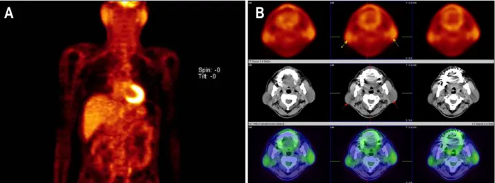 Fig.  2.  Positron  emission  tomography-computed  tomography  (PET-CT)  findings.  (A)  PET-CT  finding  showed  diffuse  hypermetabolism  in  bilateral  parotid  gland