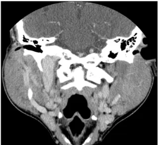 Fig.  3.  CT  scan  showed  enlarged  bilateral  parotid  gland  with  ho- ho-mogeneous  density